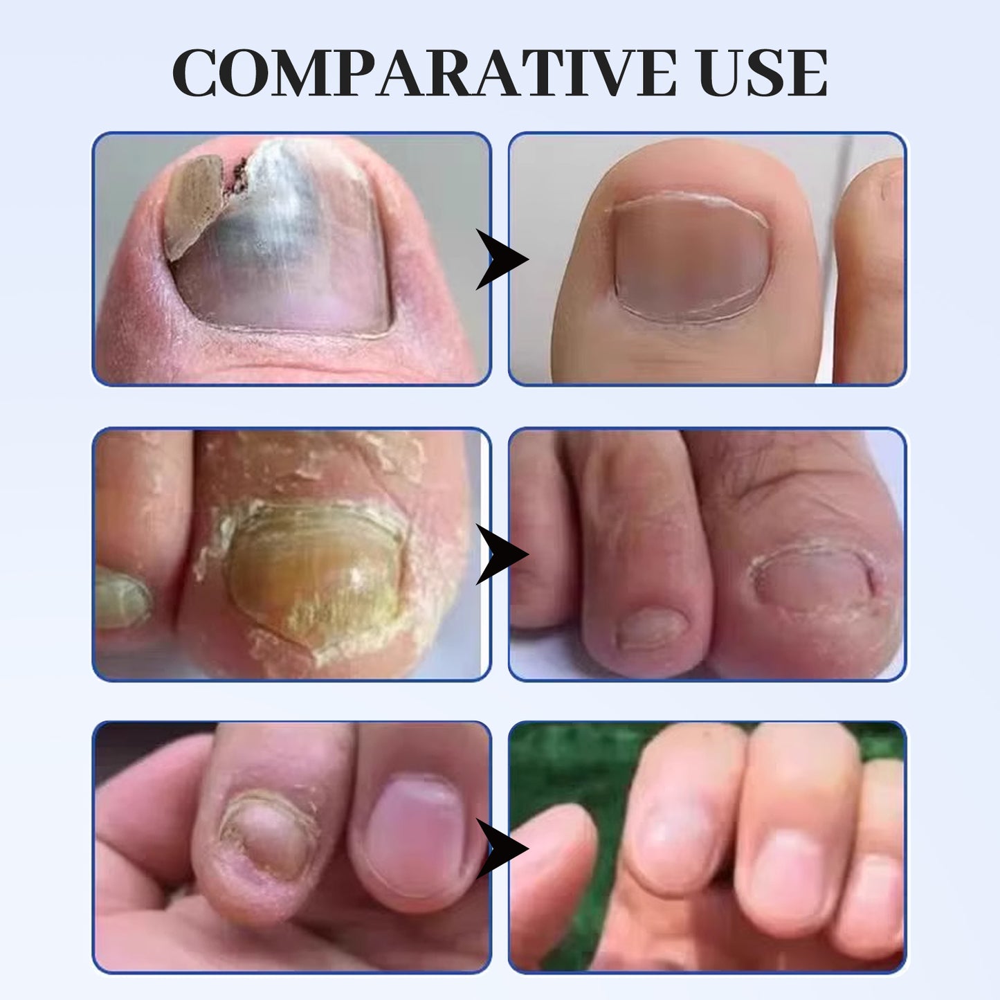 TOENAIL FUNGUS PEN - Advanced Antifungal Treatment & Nail Repair Solution for Clear, Healthy Nails