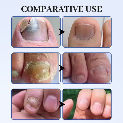 TOENAIL FUNGUS PEN - Advanced Antifungal Treatment & Nail Repair Solution for Clear, Healthy Nails
